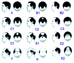 hair loss